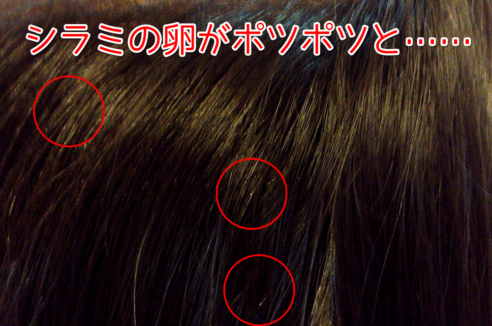 アタマジラミの症状は何ですか?